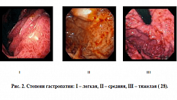 Степень выраженности портальной гипертензивной гастропатии